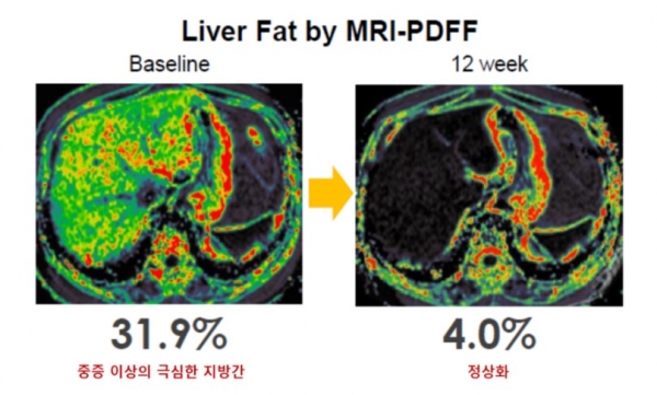 MRI-PDFF 검사로 확인한 지방간 감소 효과 (한미약품 제공)